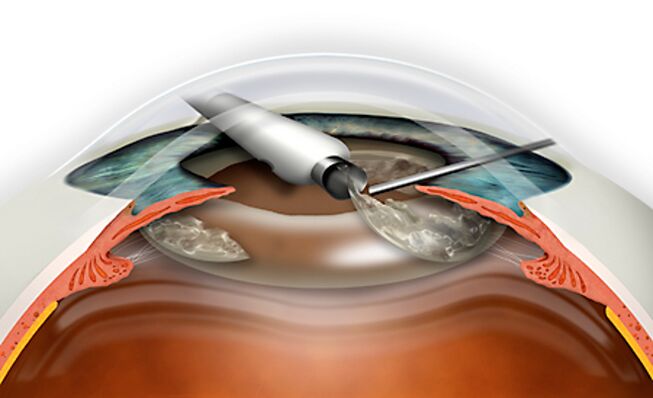 O intercambio refractivo da lente é realizado por Micronadle, exclúe a perda de sangue