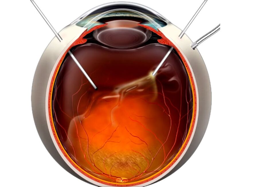 Vitrectomía un proceso que se mostra na pel de retina